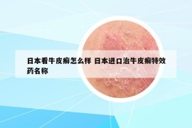 日本看牛皮癣怎么样 日本进口治牛皮癣特效药名称