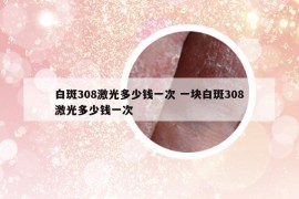 白斑308激光多少钱一次 一块白斑308激光多少钱一次