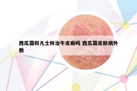 西瓜霜和凡士林治牛皮癣吗 西瓜霜皮肤病外敷