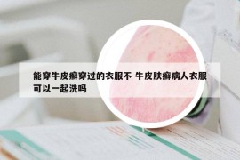 能穿牛皮癣穿过的衣服不 牛皮肤癣病人衣服可以一起洗吗