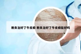 断食治好了牛皮癣 断食治好了牛皮癣能好吗