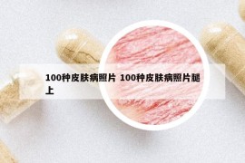 100种皮肤病照片 100种皮肤病照片腿上