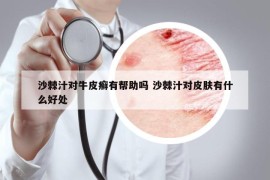 沙棘汁对牛皮癣有帮助吗 沙棘汁对皮肤有什么好处