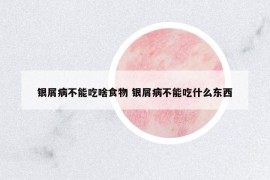银屑病不能吃啥食物 银屑病不能吃什么东西