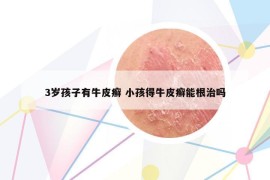 3岁孩子有牛皮癣 小孩得牛皮癣能根治吗