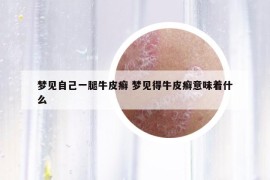 梦见自己一腿牛皮癣 梦见得牛皮癣意味着什么