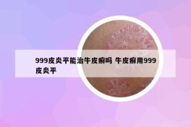 999皮炎平能治牛皮癣吗 牛皮癣用999皮炎平