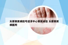 太原银屑病挂号迎泽中心银屑诚信 太原银屑病医院