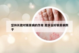 坚持长跑对银屑病的作用 跑步治好银屑病例子