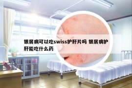 银屑病可以吃swiss护肝片吗 银屑病护肝能吃什么药