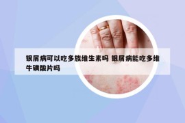 银屑病可以吃多族维生素吗 银屑病能吃多维牛磺酸片吗