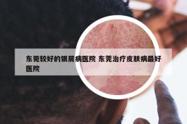 东菀较好的银屑病医院 东莞治疗皮肤病最好医院