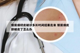 银屑病切皮破诊多长时间结果出来 银屑病皮肤破皮了怎么办