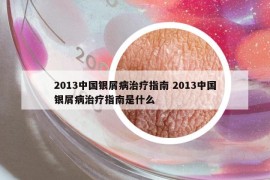 2013中国银屑病治疗指南 2013中国银屑病治疗指南是什么