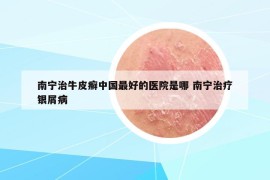 南宁治牛皮癣中国最好的医院是哪 南宁治疗银屑病