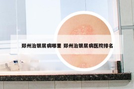 郑州治银屑病哪里 郑州治银屑病医院排名