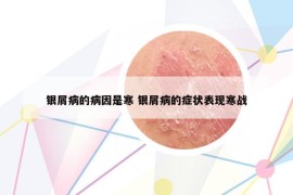 银屑病的病因是寒 银屑病的症状表现寒战
