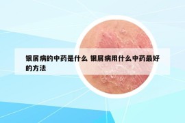 银屑病的中药是什么 银屑病用什么中药最好的方法