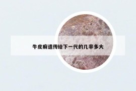 牛皮癣遗传给下一代的几率多大