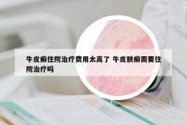 牛皮癣住院治疗费用太高了 牛皮肤癣需要住院治疗吗