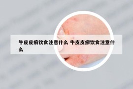 牛皮皮癣饮食注意什么 牛皮皮癣饮食注意什么