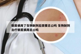 银屑病用了生物制剂后需要忌口吗 生物制剂治疗银屑病用忌口吗