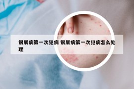 银屑病第一次犯病 银屑病第一次犯病怎么处理