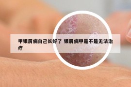 甲银屑病自己长好了 银屑病甲是不是无法治疗