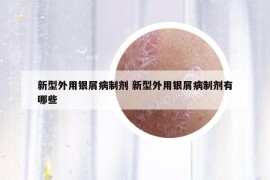 新型外用银屑病制剂 新型外用银屑病制剂有哪些
