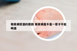 银屑病禁酒的原因 银屑病是不是一辈子不能喝酒