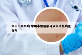 中山市银屑病 中山市银屑病可以申请慢病医保吗