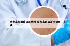 肤专家能治疗银屑病吗 肤专家银屑净治银屑病