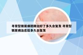 寻常型银屑病初期治好了多久会复发 寻常型银屑病治愈后多久会复发