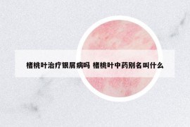 楮桃叶治疗银屑病吗 楮桃叶中药别名叫什么