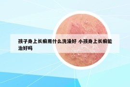 孩子身上长癣用什么洗澡好 小孩身上长癣能治好吗