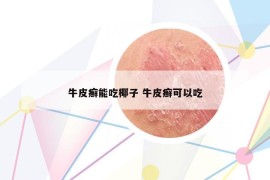 牛皮癣能吃椰子 牛皮癣可以吃