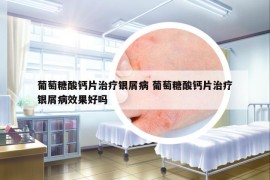 葡萄糖酸钙片治疗银屑病 葡萄糖酸钙片治疗银屑病效果好吗