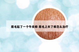 眉毛起了一个牛皮癣 眉毛上长了癣怎么治疗