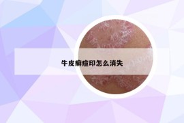 牛皮癣痘印怎么消失