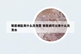 银屑病能用什么洗发露 银屑病可以用什么洗发水