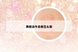 黄精治牛皮癣怎么做