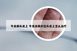 牛皮癣头皮上 牛皮皮癣长在头皮上怎么治疗