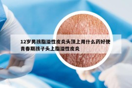 12岁男孩脂溢性皮炎头顶上用什么药好使 青春期孩子头上脂溢性皮炎