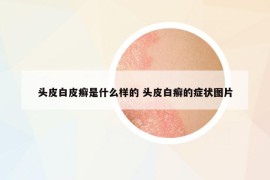 头皮白皮癣是什么样的 头皮白癣的症状图片
