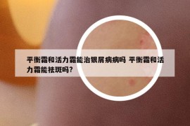 平衡霜和活力霜能治银屑病病吗 平衡霜和活力霜能祛斑吗?
