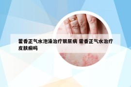 藿香正气水泡澡治疗银屑病 霍香正气水治疗皮肤癣吗
