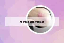 牛皮癣患者能吃猪肠吗