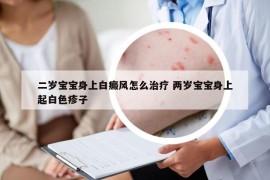 二岁宝宝身上白癜风怎么治疗 两岁宝宝身上起白色疹子