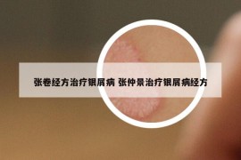 张卷经方治疗银屑病 张仲景治疗银屑病经方