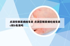 点滴性银屑病维生素 点滴型银屑病吃维生素c和b有用吗